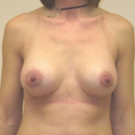 After image 1 Case #81006 - Breast Augmentation