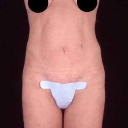 After image 1 Case #81566 - Tummy Tuck