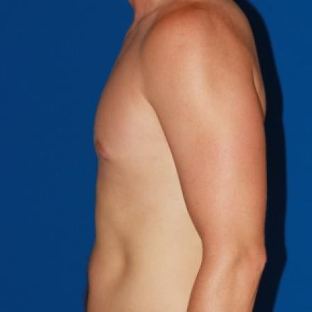 After image 3 Case #79986 - Gynecomastia male breast reduction