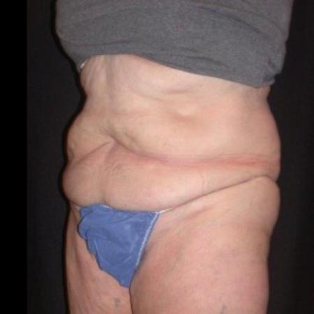 After image 2 Case #81861 - CoolSculpting