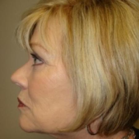 After image 4 Case #79061 - Upper and lower Eyelid Surgery