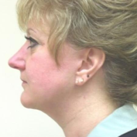 After image 1 Case #81046 - Facelift