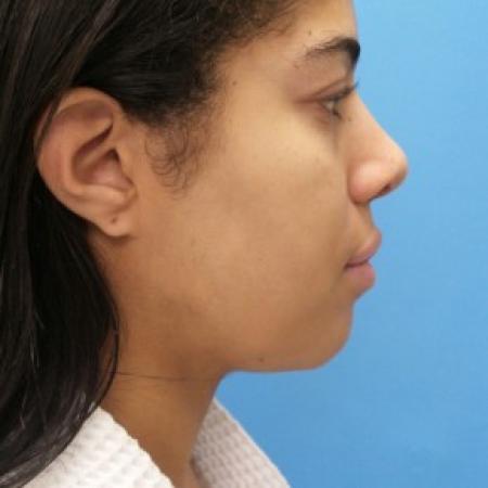 After image 2 Case #86446 - Rhinoplasty - 3 months post-op