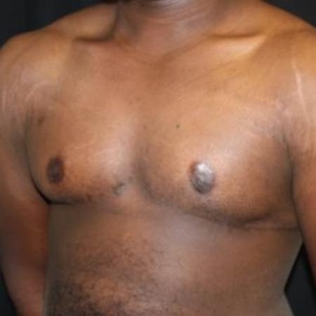After image 2 Case #83056 - 22 year old Gynecomastia