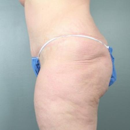After image 2 Case #83346 - Abdominoplasty