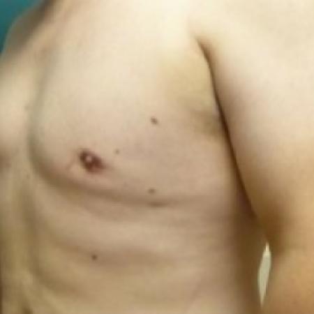 After image 2 Case #86676 - Gynecomastia Correction