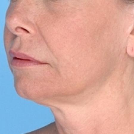 After image 1 Case #79326 - Non-Surgical Focused Ultrasound