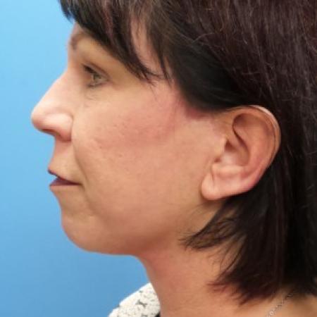 After image 3 Case #86566 - Facelift/Lower Blepharoplasty/Browlift/Laser Resurfacing to Full Face     4 months post-op