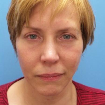 After image 1 Case #87401 - 54-year old  -  Facelift/Upper Blepharoplasty/Lower Lid Fat Grafting & TCA Peel   3-months post-op
