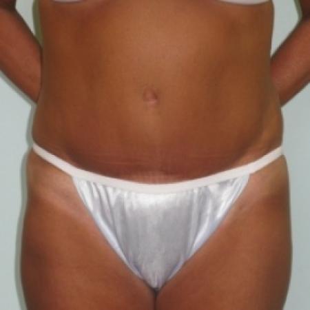 After image 1 Case #79921 - Tummy Tuck 