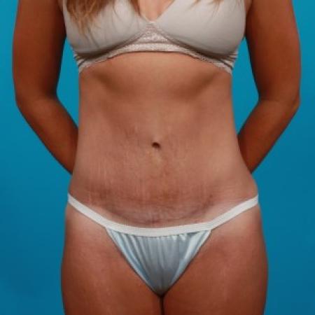 After image 1 Case #81941 - Abdominoplasty
