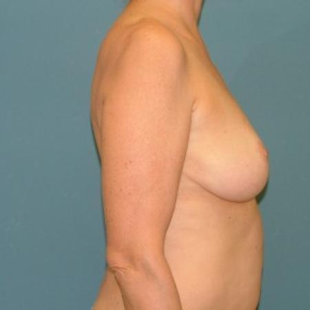 After image 3 Case #86721 - Breast Reduction inferior pedicle