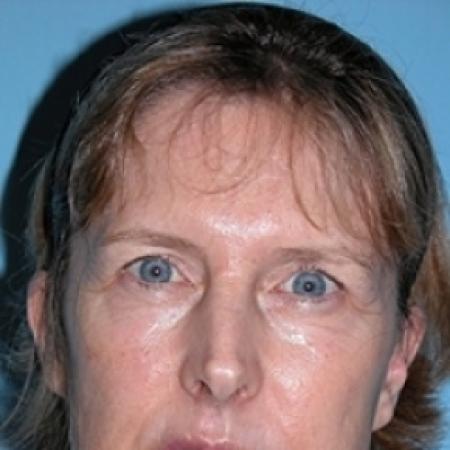 After image 1 Case #79276 - Facelift