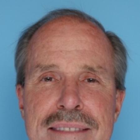 After image 1 Case #79681 - Facelift
