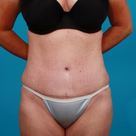After image 1 Case #84101 - Abdominoplasty with Flank Lipo