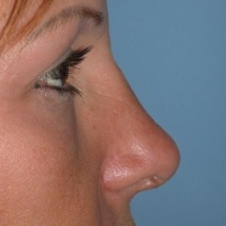 After image 2 Case #79256 - Rhinoplasty