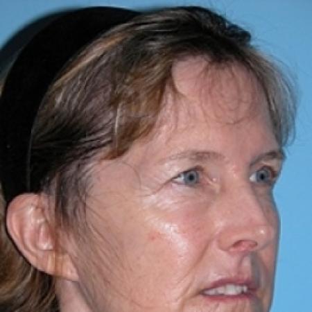 After image 3 Case #79276 - Facelift