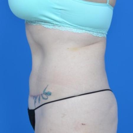 After image 3 Case #87866 - Tummy Tuck