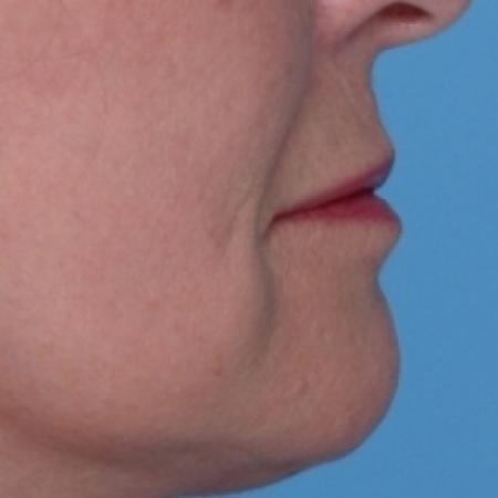 After Case #80576 - Lip Augmentation