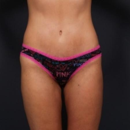 After image 1 Case #79636 - Tummy Tuck