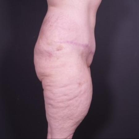 After image 2 Case #85256 - Abdominoplasty after Bariatric Surgery