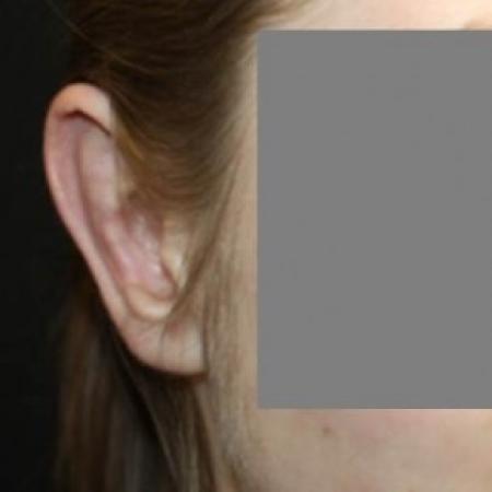 After image 2 Case #84636 - Otoplasty - 17 year old female