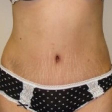 After image 1 Case #79481 - Tummy Tuck