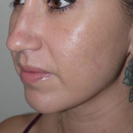 After image 2 Case #82556 - Liposuction of the chin and neck