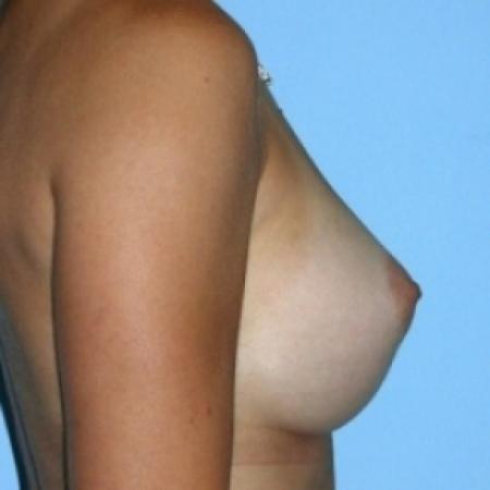 After image 2 Case #79071 - Saline Breast Implants