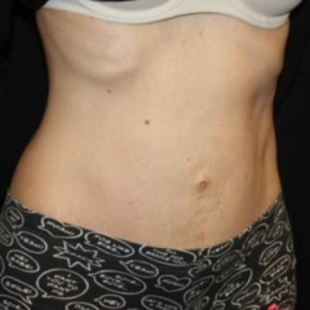 After image 2 Case #84861 - Abdominoplasty - 42 year old female