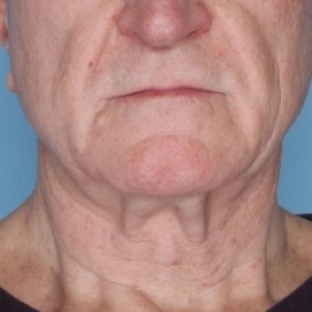 After image 1 Case #80626 - Ulthera