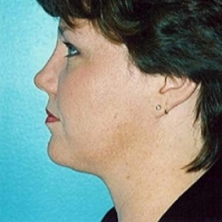 After image 2 Case #79196 - Liposuction