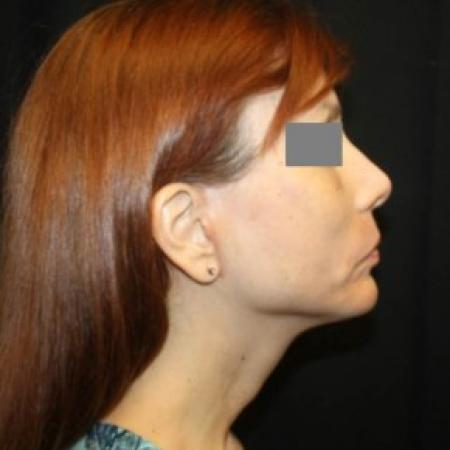 After image 3 Case #84386 - Facelift/Facial Rejuvenation - 54 year old female
