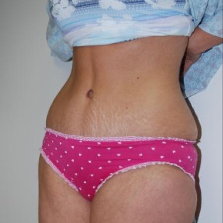 After image 2 Case #85811 - Traditional abdominoplasty after children