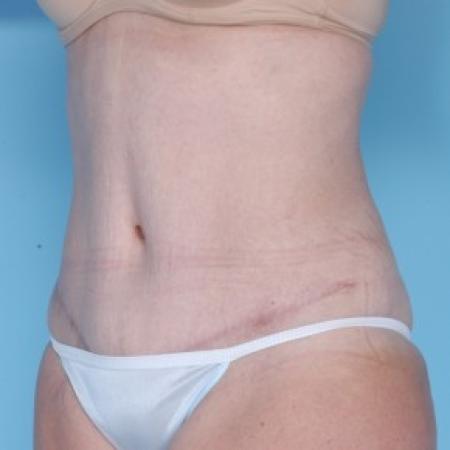 After image 2 Case #82246 - Liposuction