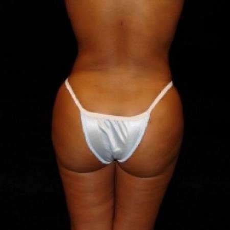 After image 5 Case #80491 - Buttocks Augmentation Via Fat Grafting with Liposuction of Abdomen, Waist, Flanks, and Dorsal Roll