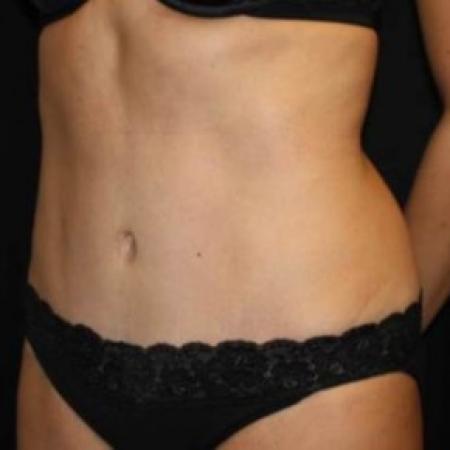 After image 2 Case #83391 - Abdominoplasty - 39 year old female.