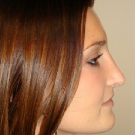 After image 2 Case #79961 - Open Rhinoplasty