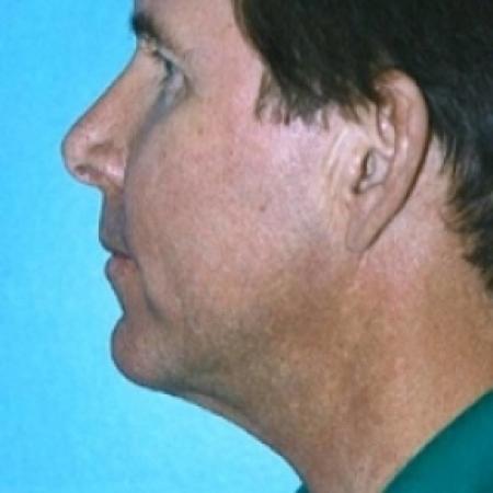 After image 2 Case #79211 - Liposuction