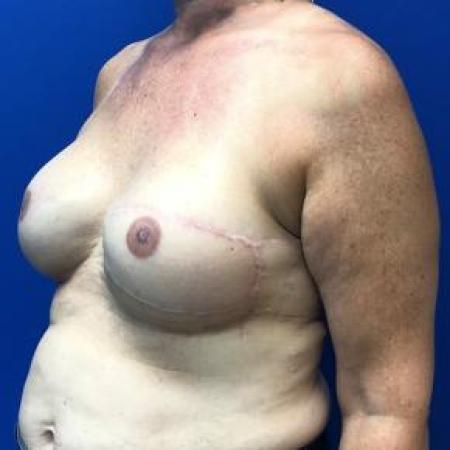 After image 2 Case #88201 - Breast Reconstruction on a 49 year old female