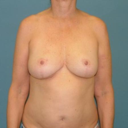 After image 1 Case #86721 - Breast Reduction inferior pedicle