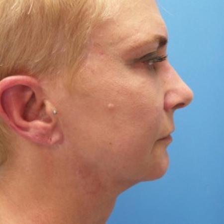 After image 3 Case #87176 - 57 year old  -  Facelift/Laser Resurfacing under eyes  -  1 year - 7 months post-op