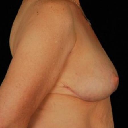 After image 3 Case #81456 - Breast Reduction/Lift