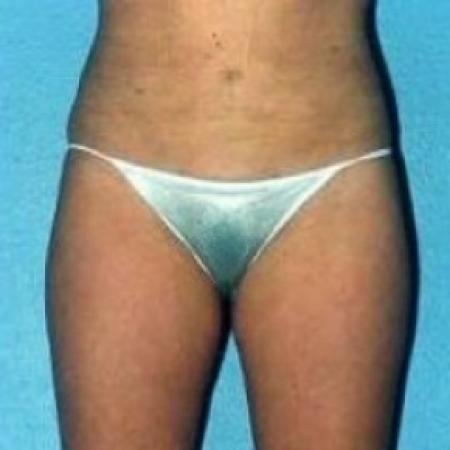 After image 1 Case #79186 - Liposuction