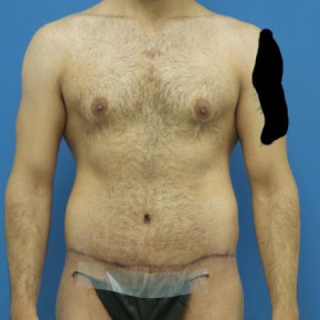 After Case #88451 - Circumferential Body Lift /Gynecomastia Reduction