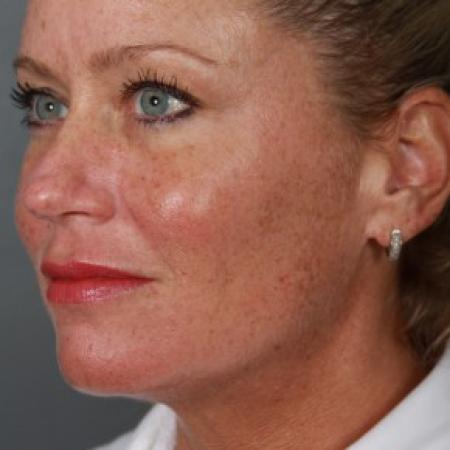 After image 2 Case #83606 - Neck Liposuction