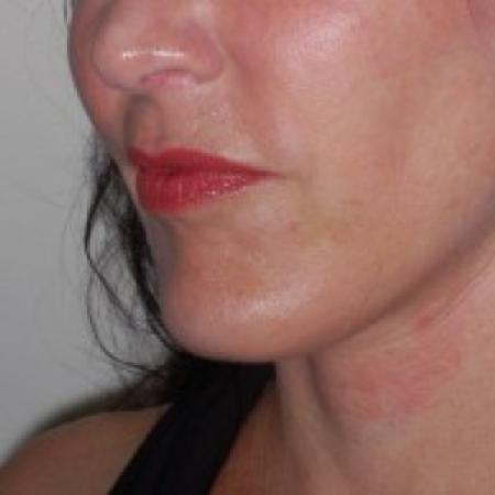 After image 1 Case #87216 - Chin Implant