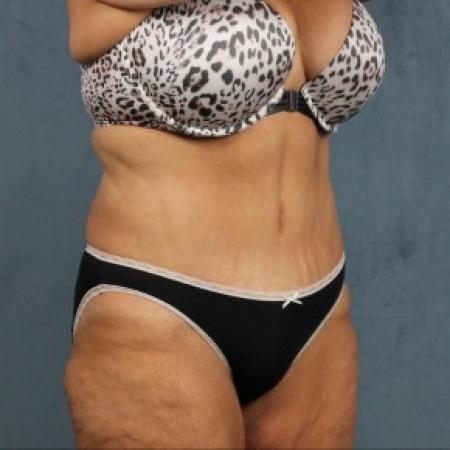 After image 2 Case #82551 - extended abdominoplasty (tummy tuck) after massive weight loss