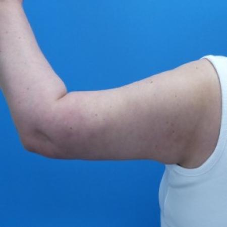 After image 2 Case #86956 - 51 year old   -    Brachioplasty (Arm Lift)   -  5 months post-op