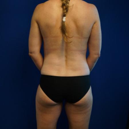 After image 5 Case #88366 - 46 year old female after Mommy Makeover